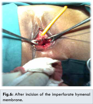what is vaginal incision Show me your pussy tubes